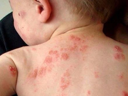 Dấu hiệu bệnh zona ở trẻ em