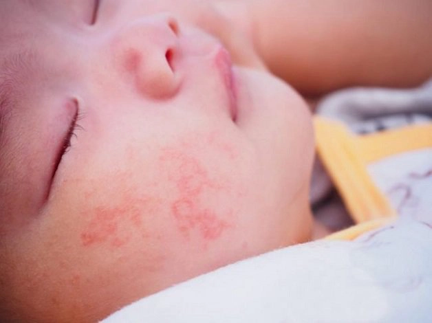 Dấu hiệu nấm da ở trẻ sơ sinh