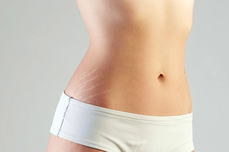 Dấu hiệu rạn da trên hông