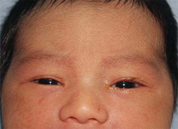 Dấu hiệu tắc tuyến lệ ở trẻ sơ sinh