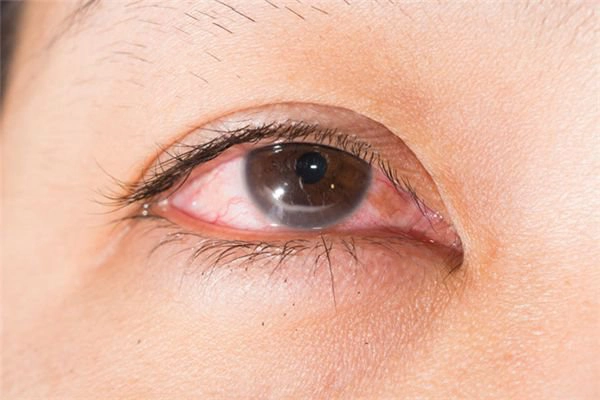 Đau kèm đỏ mắt, tròng trắng mắt nhô cao hơn tròng đen là bệnh gì?