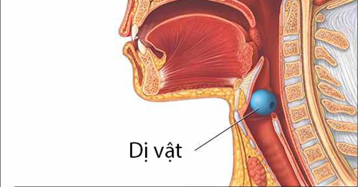 Dị vật đường thở bỏ quên ở trẻ em