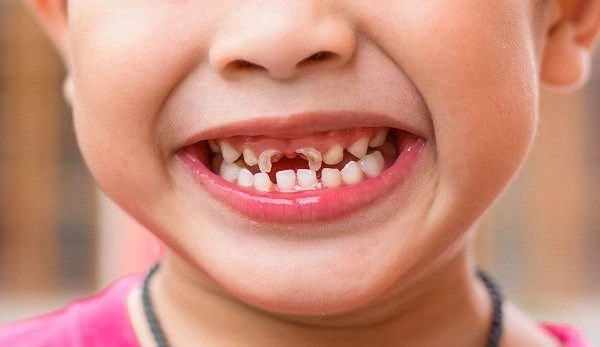 Điều gì xảy ra khi bạn không đánh răng