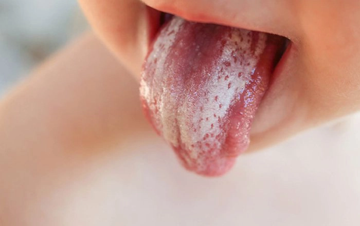 Điều trị bệnh nấm lưỡi ở người lớn và trẻ em
