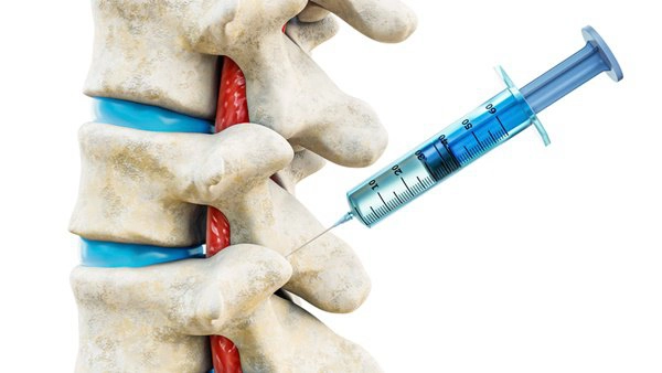 Điều trị đau trong thoát vị đĩa đệm thắt lưng bằng phương pháp tiêm Corticoid ngoài màng cứng qua lỗ liên hợp