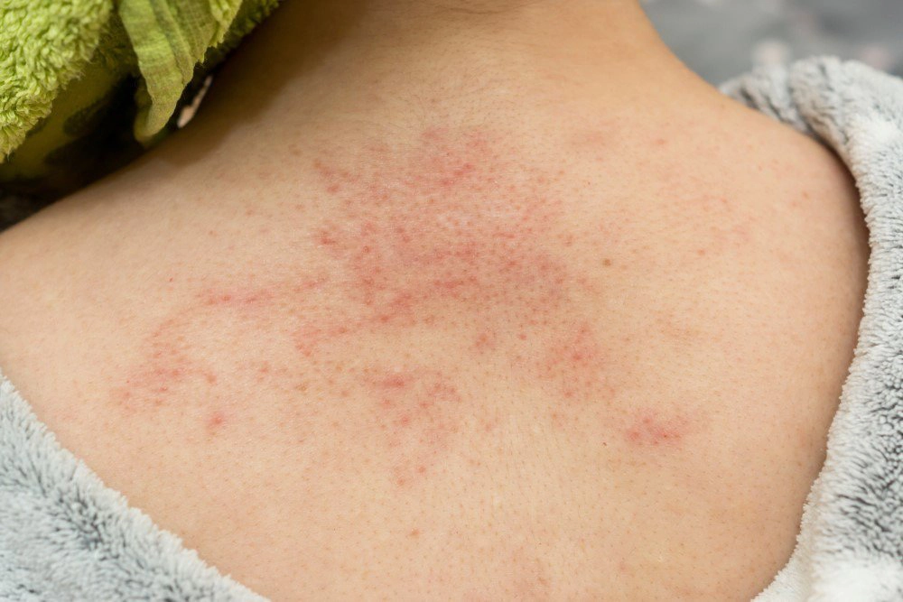 Điều trị dứt điểm viêm nang lông thế nào?