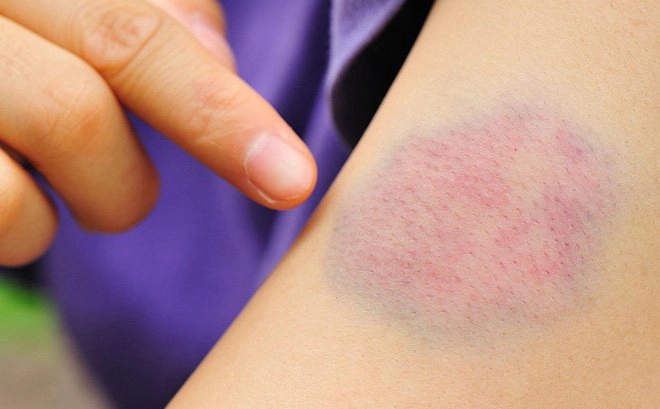 Điều trị giảm tiểu cầu vô căn