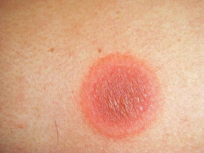 Điều trị hồng ban nhiễm sắc cố định như thế nào?