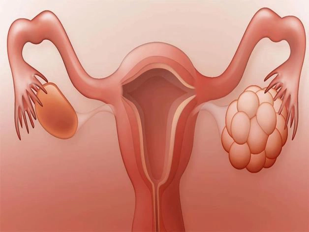 Điều trị nang buồng trứng phải
