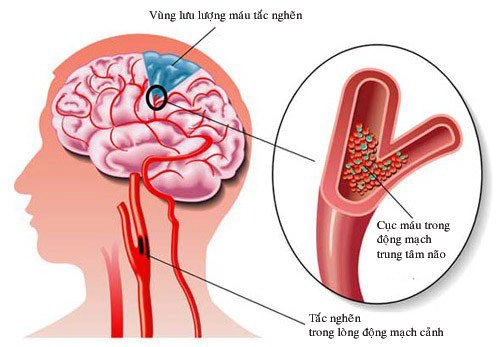 Điều trị nhồi máu não bằng thuốc tiêu sợi huyết