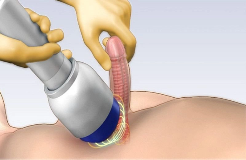 Điều trị rối loạn cương dương bằng sóng xung kích