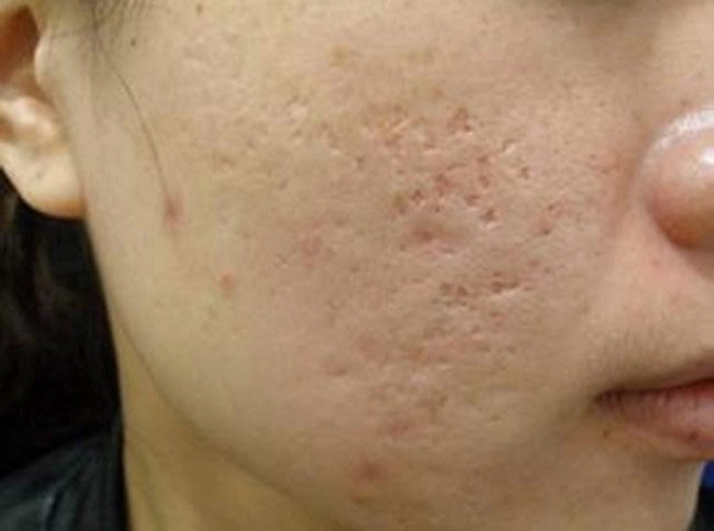 Điều trị sẹo rỗ ở mặt thế nào?