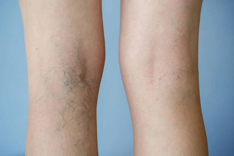 Điều trị suy giãn tĩnh mạch chi dưới như thế nào?