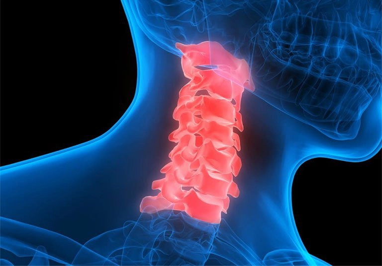 Điều trị tổn thương tủy cổ cấp