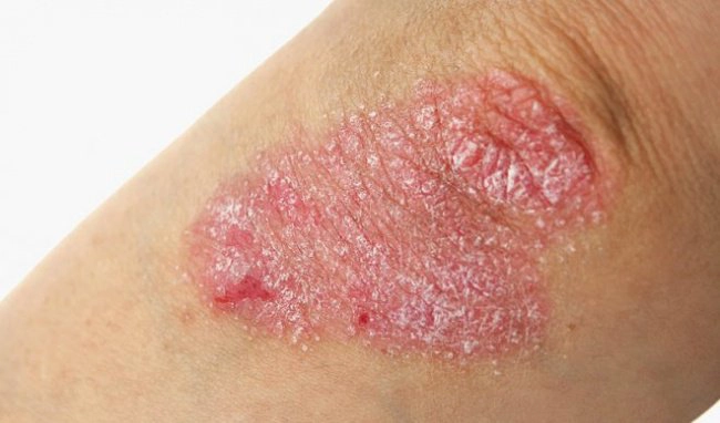 Điều trị vảy nến trên bệnh nhân HIV