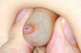 Điều trị viêm bao quy đầu