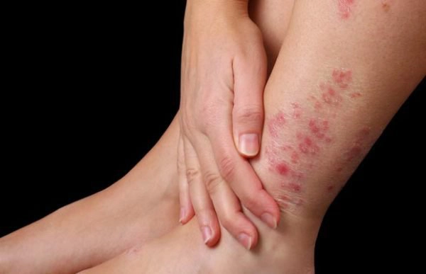 Điều trị viêm da cơ địa thế nào?