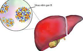 Điều trị viêm gan B mạn tính như thế nào?
