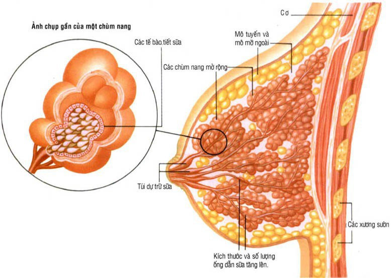 Điều trị xơ nang tuyến vú