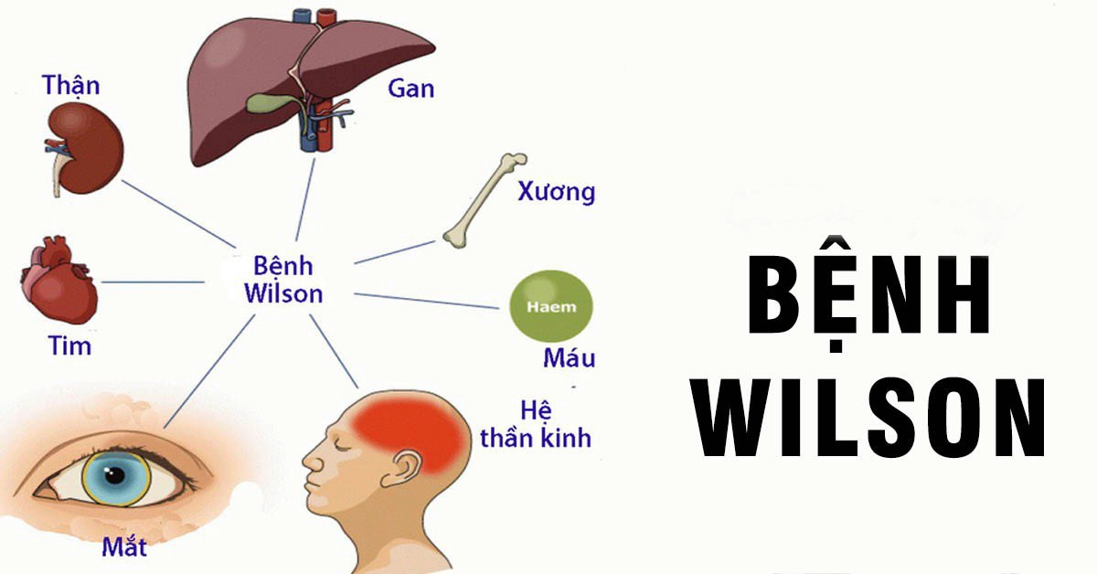 Đột biến gen ATP7B ở bệnh nhân Wilson