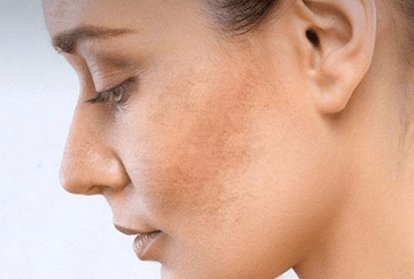 Dùng retinol bị sạm da phải làm sao?