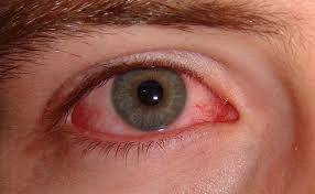 F0 bị đỏ mắt, phải làm thế nào?
