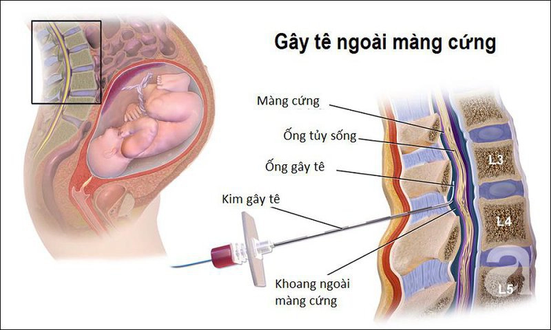 Gây tê ngoài màng cứng có tác dụng gì?