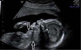 Giải đáp các thắc mắc về bướu giáp thai nhi - fetal goitre