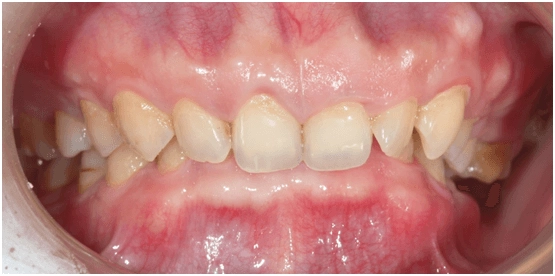 Giải pháp điều trị răng bị thụt vào trong