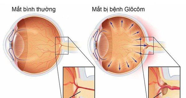 Glocom góc mở có thể laser chữa tật khúc xạ được không?