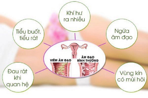 Gợi ý cách phòng tránh viêm phụ khoa cho chị em