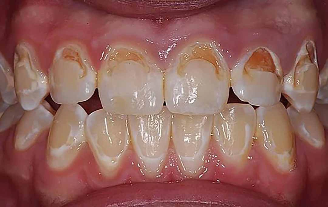 Hậu quả khi răng thiếu canxi