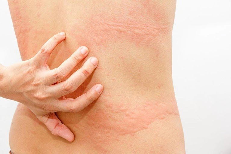 Hay ngứa dị ứng nổi mề đay phải làm sao?