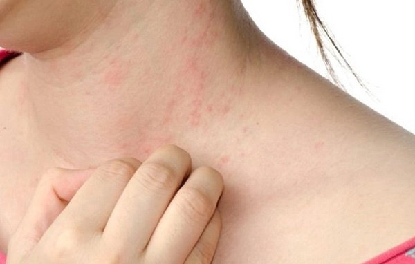Herpes da và vẩy nến gây mẩn ngứa, nên dùng kem dưỡng thế nào?