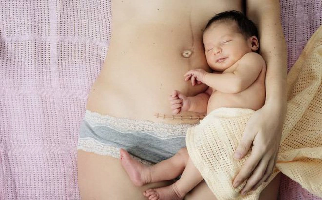 Hiểu đúng về giảm đau và chăm sóc sau sinh mổ