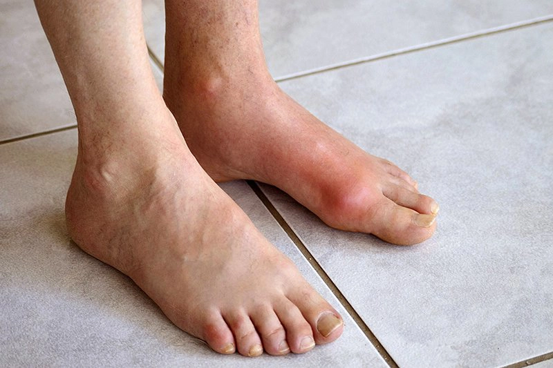 Hình ảnh bệnh gút trên bàn chân và khớp