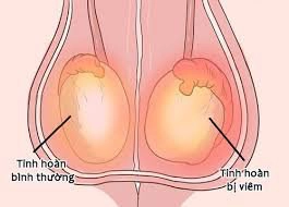 Hình ảnh viêm tinh hoàn có dễ phân biệt?