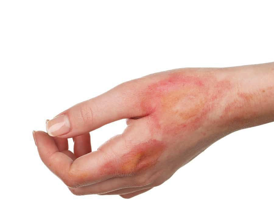 Hoại tử thượng bì nhiễm độc là bệnh gì?