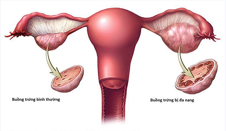 Hội chứng buồng trứng đa nang gây ra vấn đề gì?
