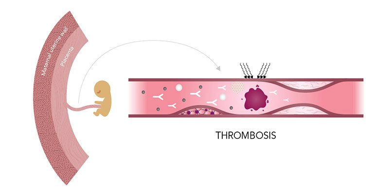 Hội chứng kháng Phospholipid (APS) với phụ nữ mang thai