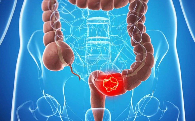 Hội chứng ung thư đại trực tràng di truyền không do polyp (HNPCC)