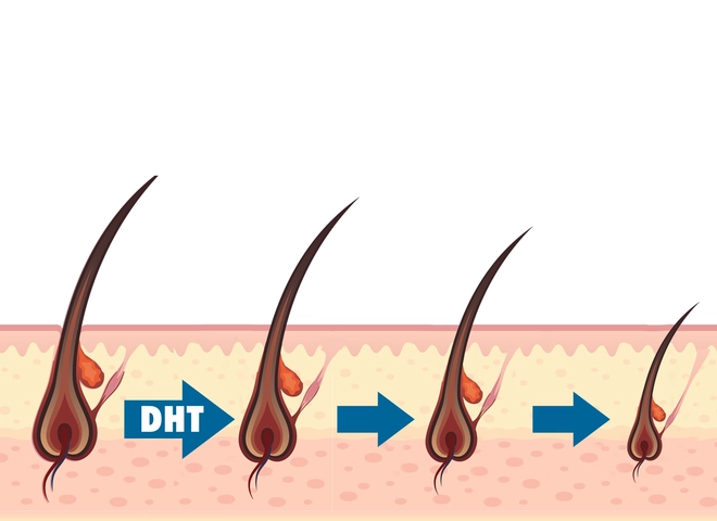 Hormone Dihydrotestosterone là gì?