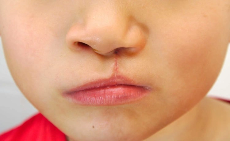 Hướng dẫn chăm sóc trẻ có khe hở môi, vòm miệng