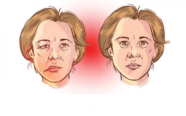 Hướng dẫn đầy đủ về bệnh nhược cơ