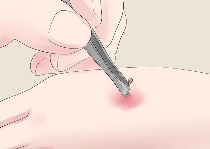 Hướng dẫn sơ cứu ong đốt