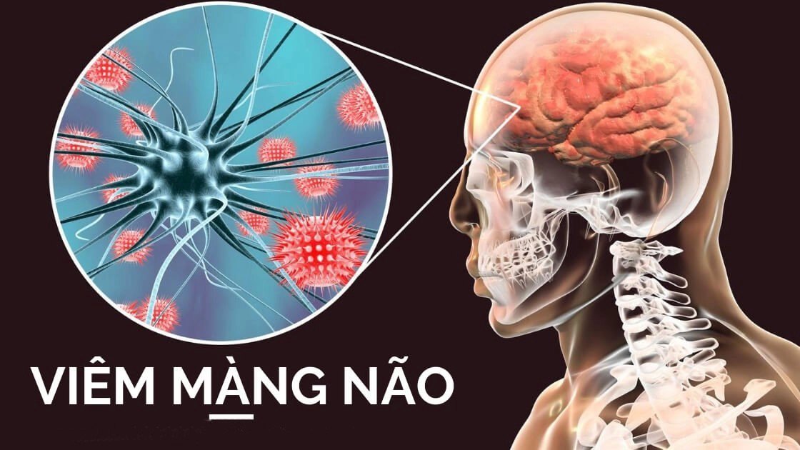 Hướng dẫn trực quan về bệnh viêm màng não