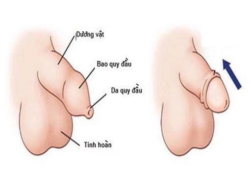 Hướng dẫn vệ sinh bao quy đầu cho trẻ sơ sinh