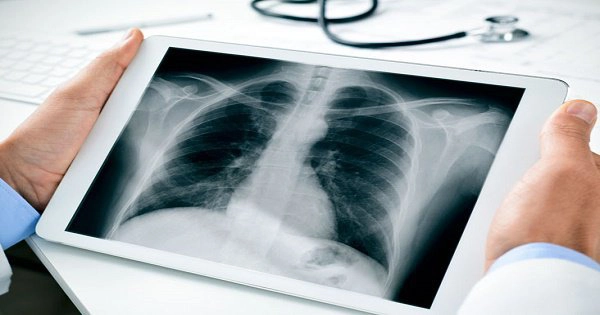 Kết quả chụp X - quang phổi có nốt mờ có sao không?