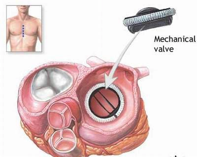 Khả năng hồi phục của người bệnh tai biến mạch máu não có cao không?