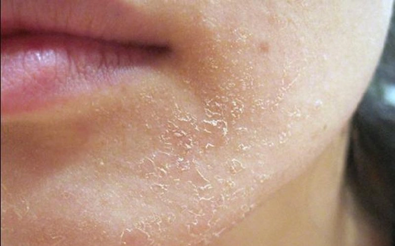 Khắc phục da khô ở tuổi 25 như thế nào?